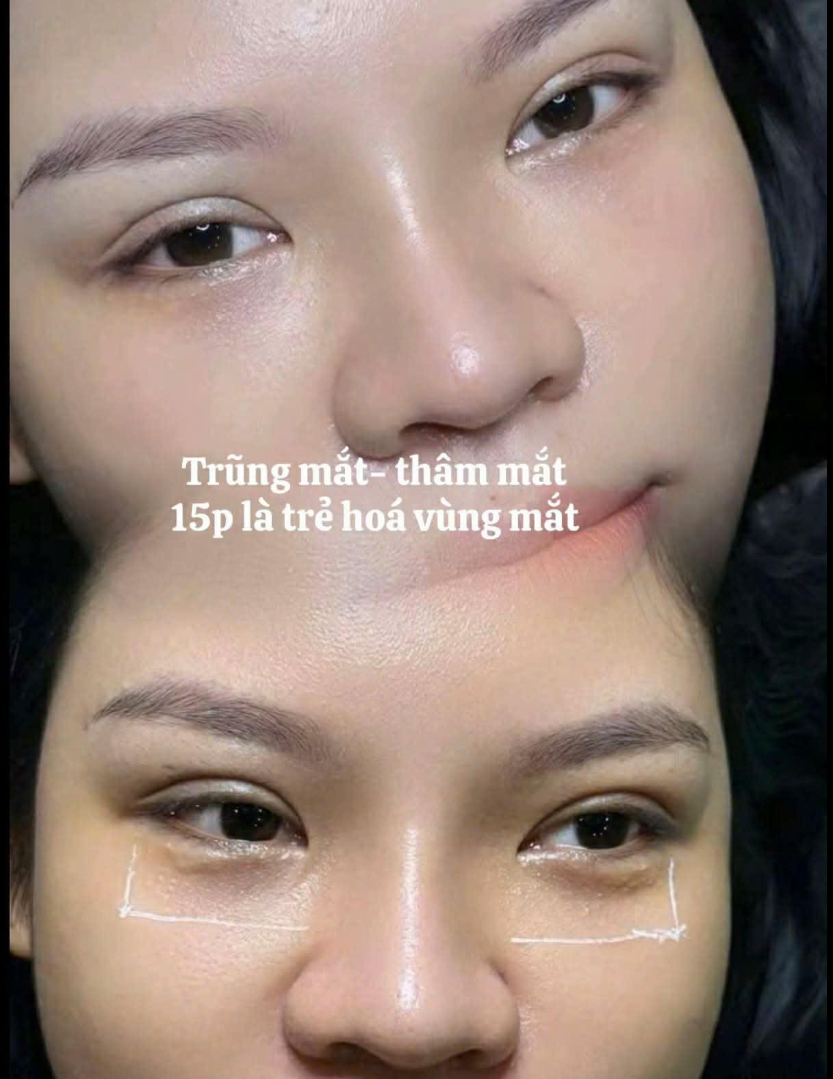 Kết quả Trẻ hóa vùng mắt