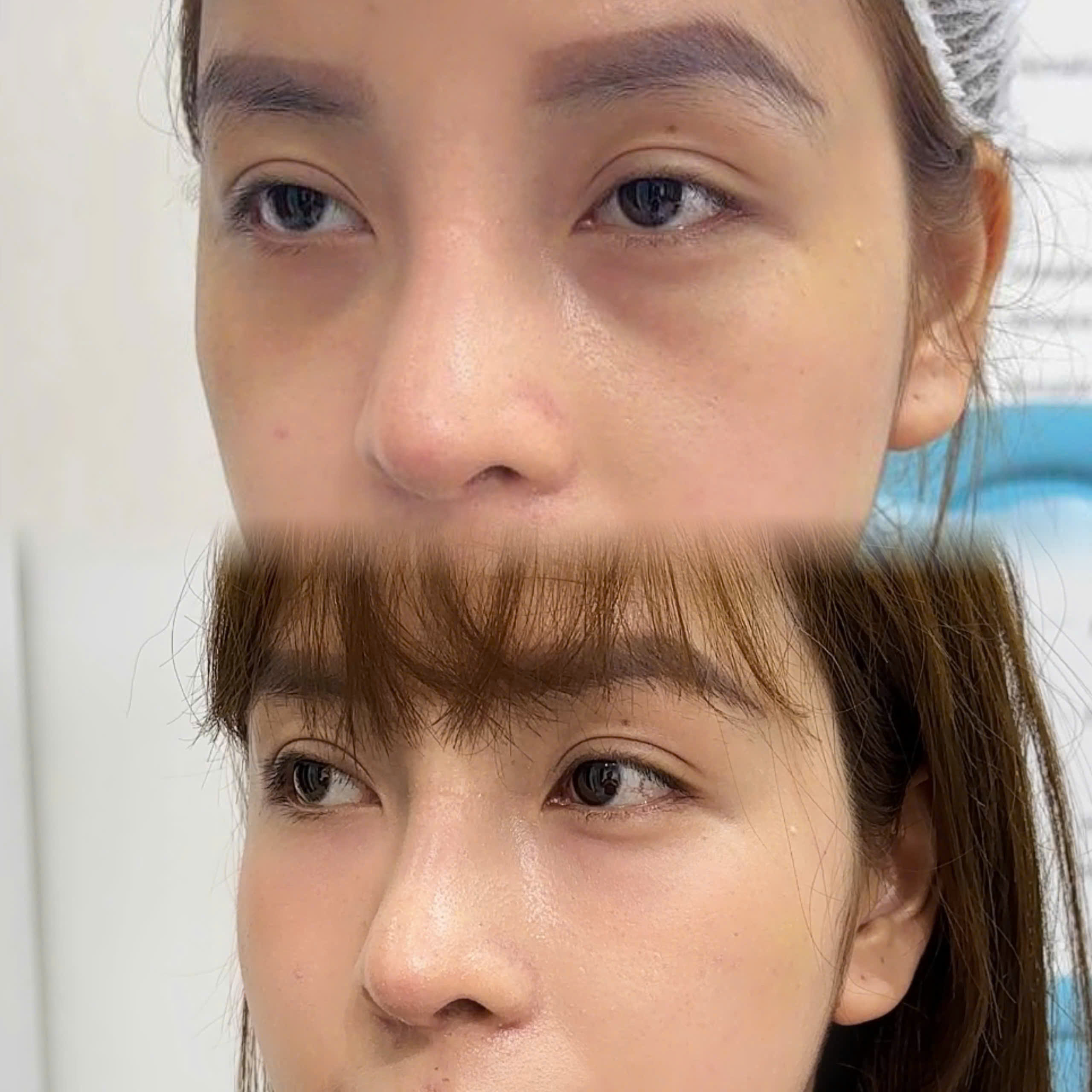 Chăm sóc sau filler: những điều nên lưu ý