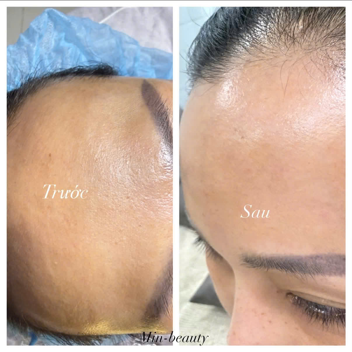 Những hiểu lầm thường gặp về filler