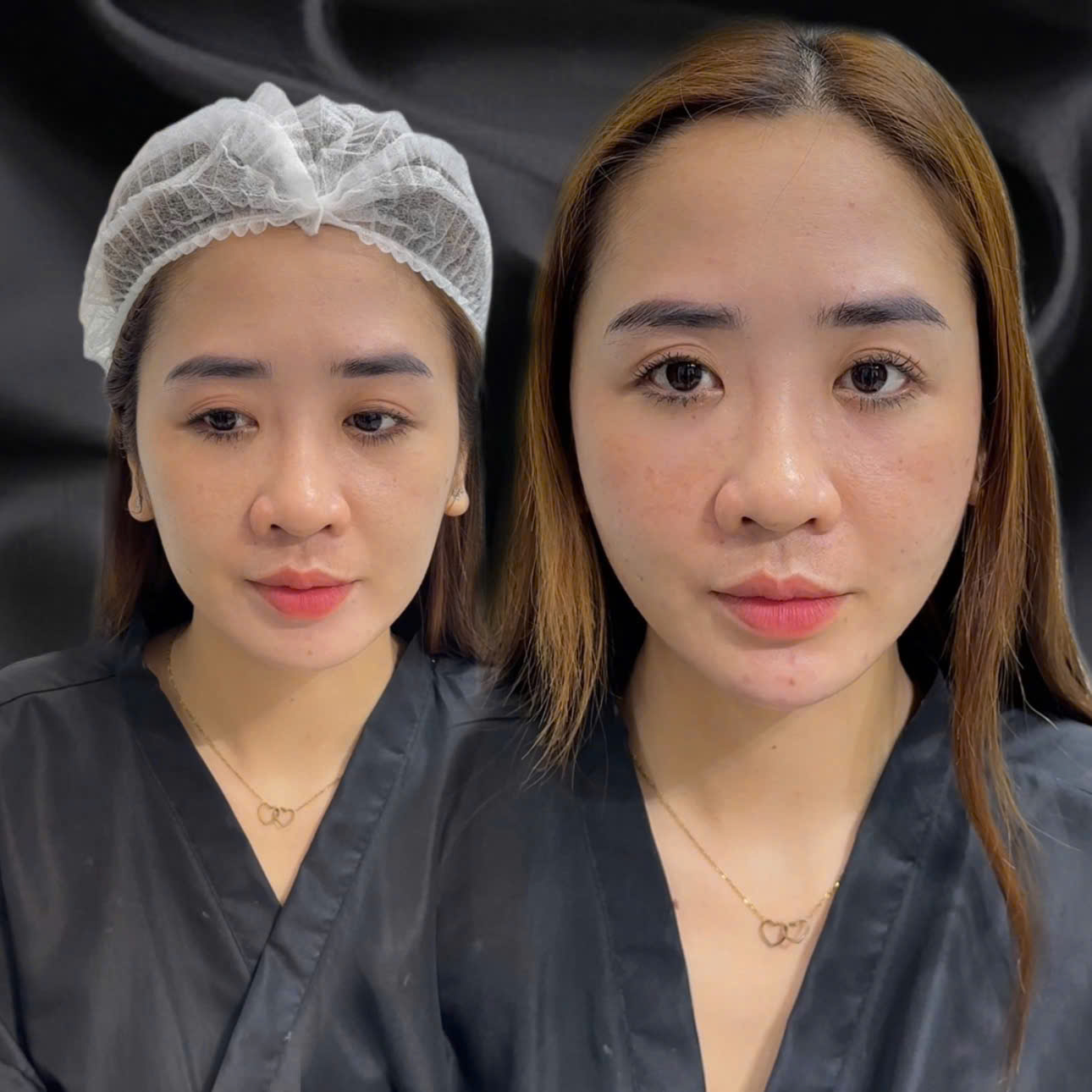 Khi nào nên làm đầy tầng mặt giữa?