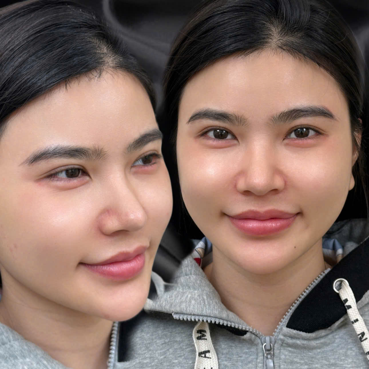 Bọng mắt cười