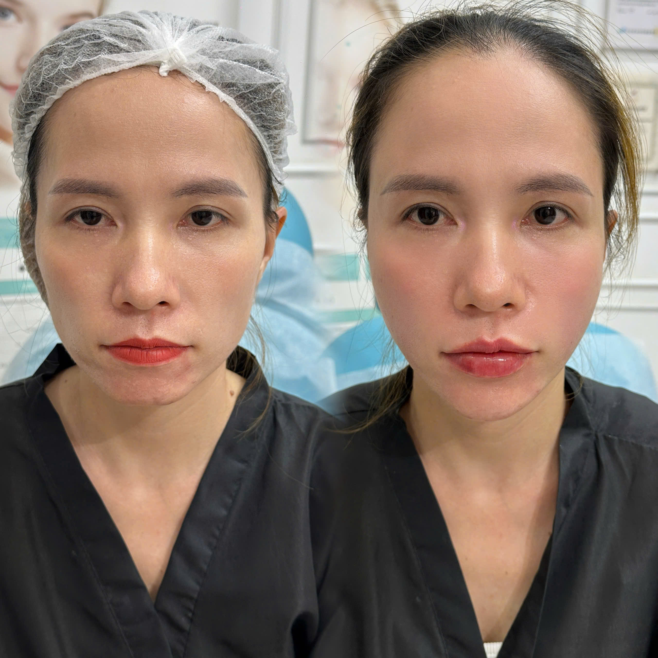 Nâng tầng mặt giữa